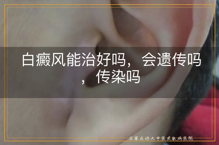 白癜风能治好吗，会遗传吗，传染吗