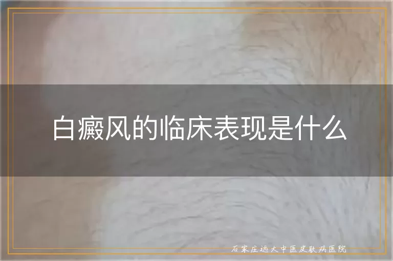 白癜风的临床表现是什么