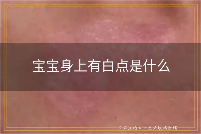 宝宝身上有白点是什么