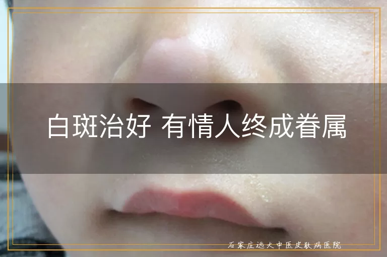 白斑治好 有情人终成眷属