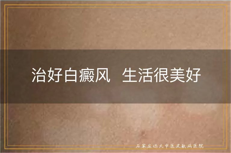 治好白癜风  生活很美好