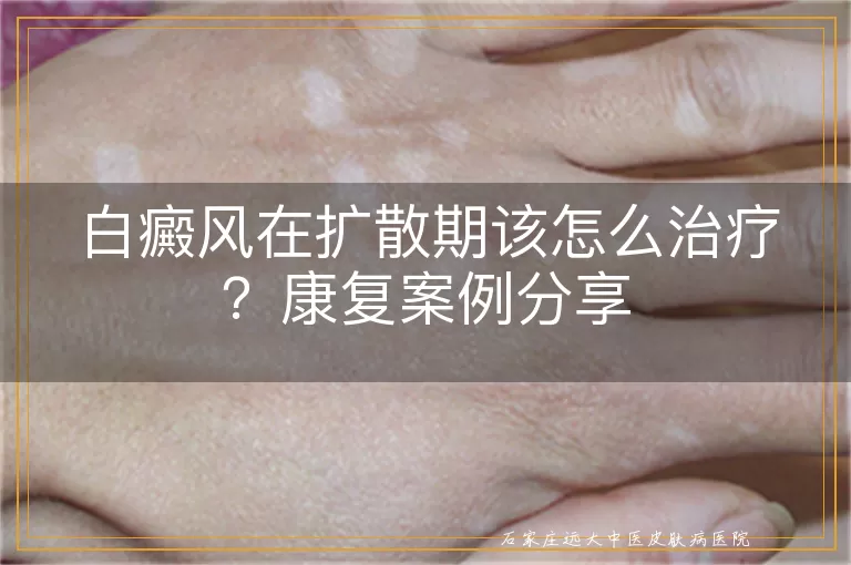 白癜风在扩散期该怎么治疗？康复案例分享