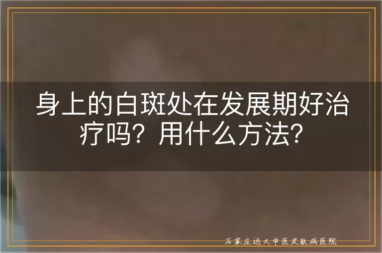 身上的白斑处在发展期好治疗吗？用什么方法？