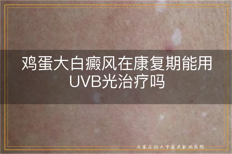 鸡蛋大白癜风在康复期能用UVB光治疗吗