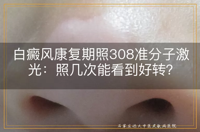 白癜风康复期照308准分子激光：照几次能看到好转？