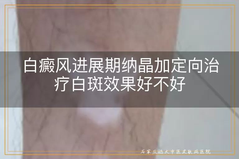 白癜风进展期纳晶加定向治疗白斑效果好不好