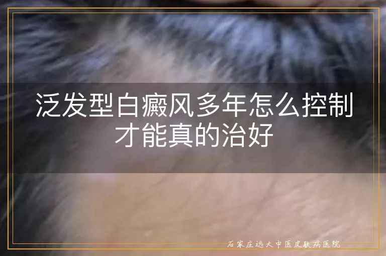 泛发型白癜风多年怎么控制才能真的治好