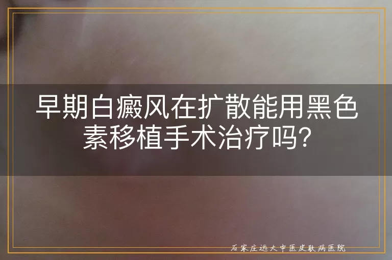 早期白癜风在扩散能用黑色素移植手术治疗吗？