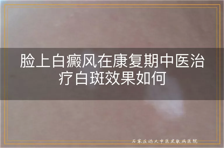 脸上白癜风在康复期中医治疗白斑效果如何