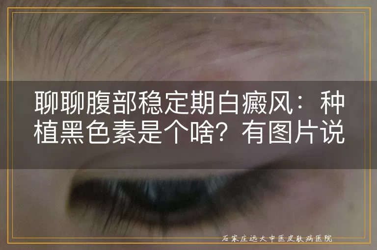 聊聊腹部稳定期白癜风：种植黑色素是个啥？有图片说明哦！