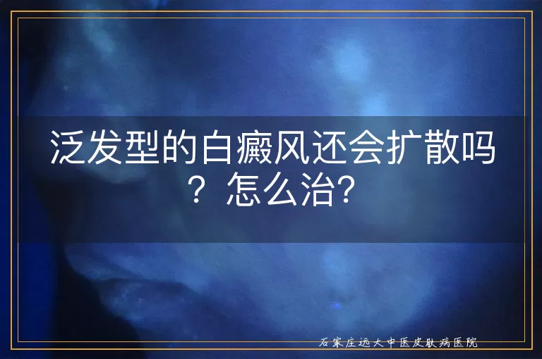 泛发型的白癜风还会扩散吗？怎么治？