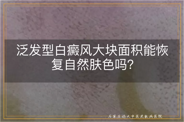 泛发型白癜风大块面积能恢复自然肤色吗？