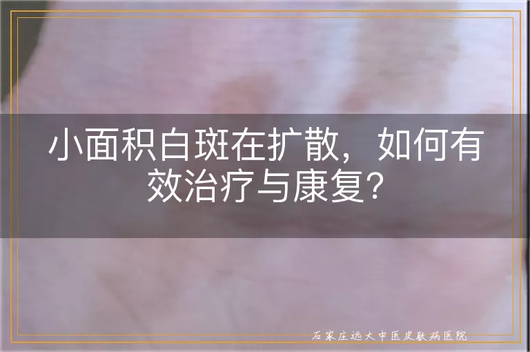 小面积白斑在扩散，如何有效治疗与康复？