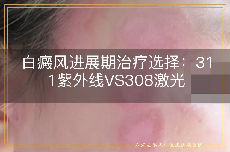 白癜风进展期治疗选择：311紫外线VS308激光