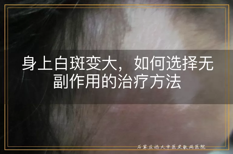 身上白斑变大，如何选择无副作用的治疗方法