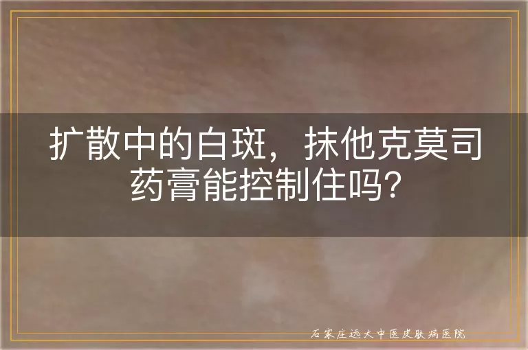 扩散中的白斑，抹他克莫司药膏能控制住吗？
