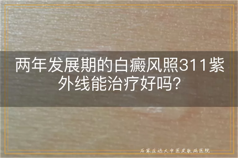 两年发展期的白癜风照311紫外线能治疗好吗？