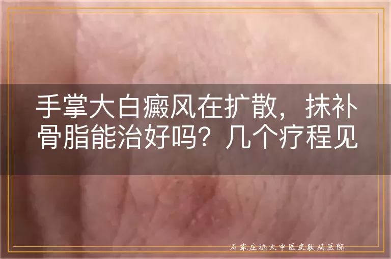 手掌大白癜风在扩散，抹补骨脂能治好吗？几个疗程见效？
