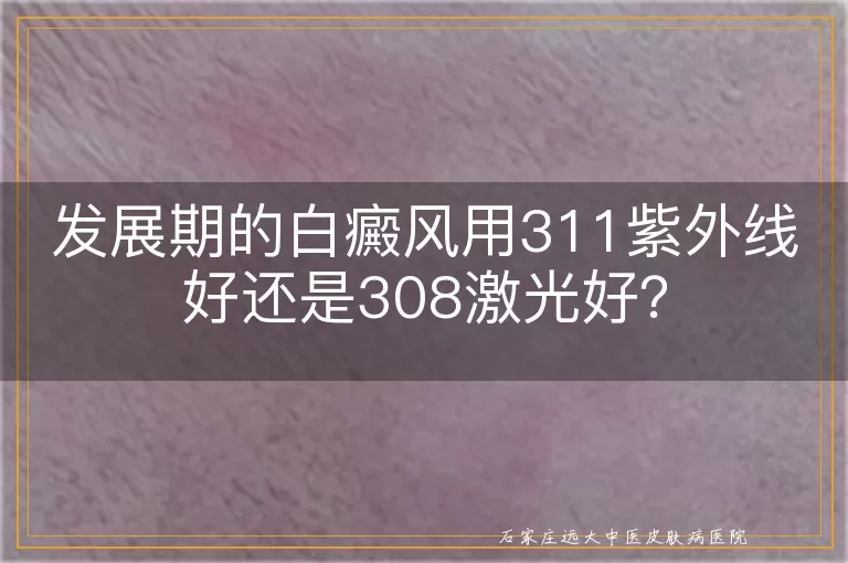 发展期的白癜风用311紫外线好还是308激光好？