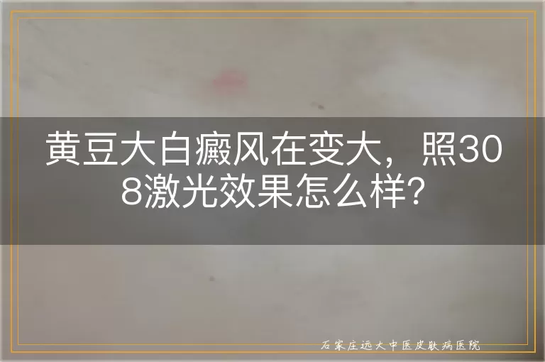 黄豆大白癜风在变大，照308激光效果怎么样？