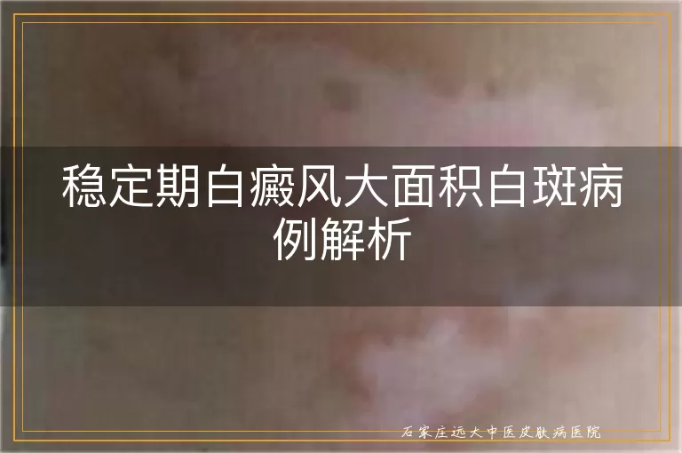 稳定期白癜风大面积白斑病例解析