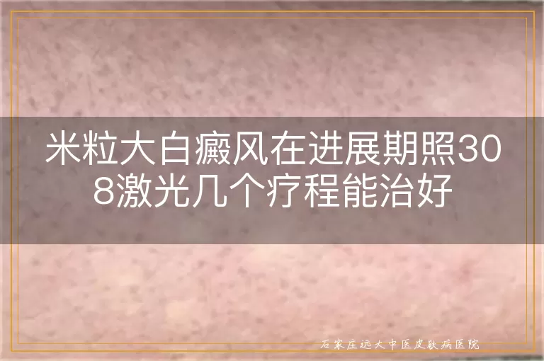 米粒大白癜风在进展期照308激光几个疗程能治好