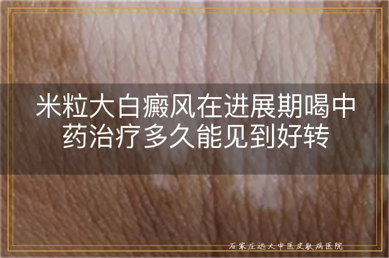 米粒大白癜风在进展期喝中药治疗多久能见到好转
