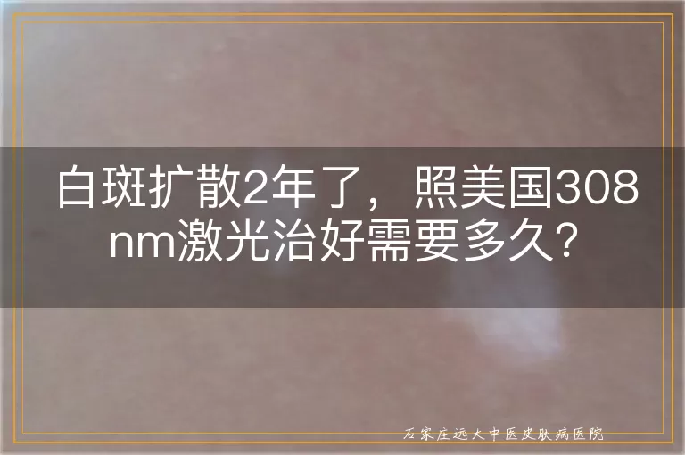 白斑扩散2年了，照美国308nm激光治好需要多久？