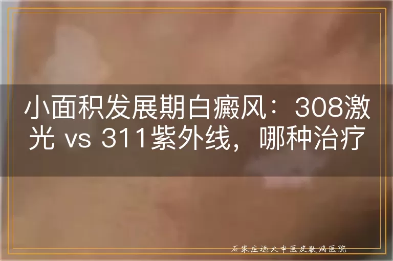 小面积发展期白癜风：308激光 vs 311紫外线，哪种治疗更优？