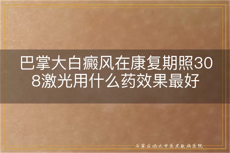 巴掌大白癜风在康复期照308激光用什么药效果最好