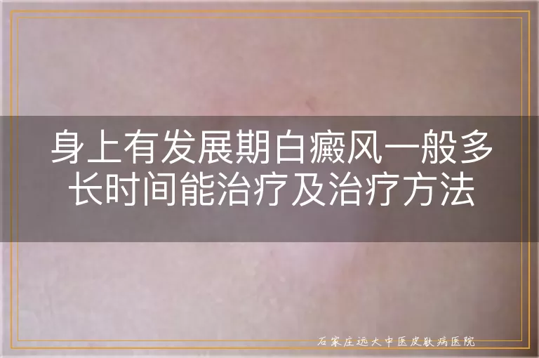 身上有发展期白癜风一般多长时间能治疗及治疗方法