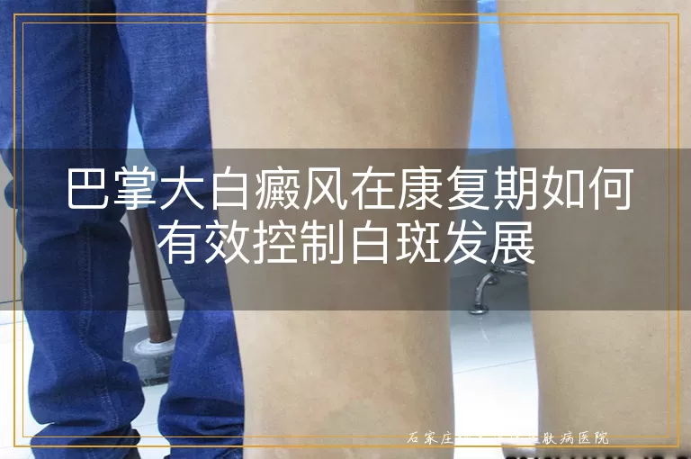 巴掌大白癜风在康复期如何有效控制白斑发展