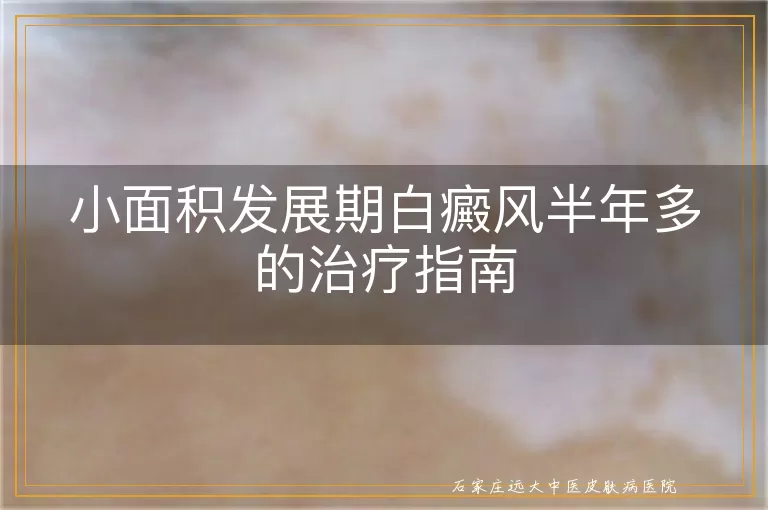 小面积发展期白癜风半年多的治疗指南