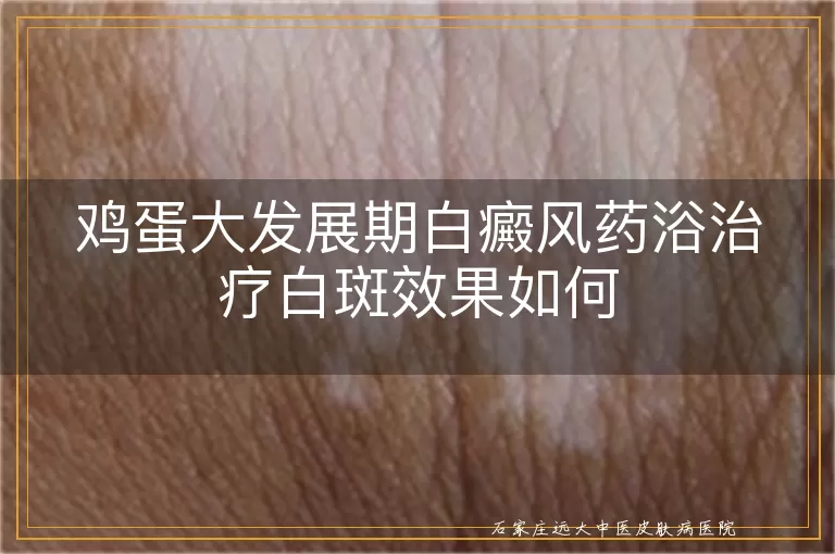 鸡蛋大发展期白癜风药浴治疗白斑效果如何