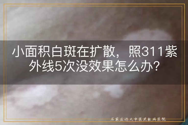 小面积白斑在扩散，照311紫外线5次没效果怎么办？
