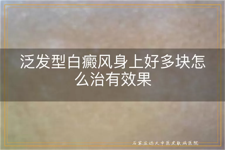 泛发型白癜风身上好多块怎么治有效果