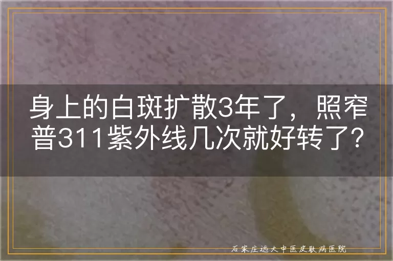 身上的白斑扩散3年了，照窄普311紫外线几次就好转了？