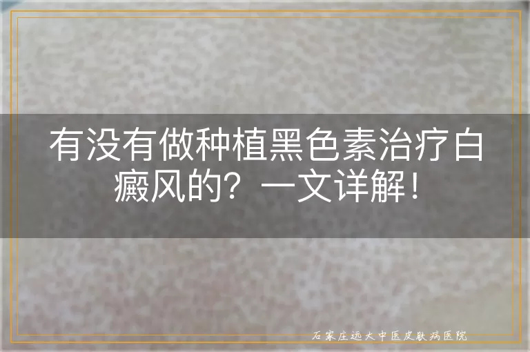 有没有做种植黑色素治疗白癜风的？一文详解！