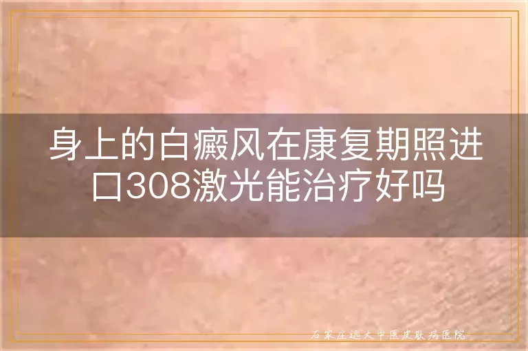 身上的白癜风在康复期照进口308激光能治疗好吗