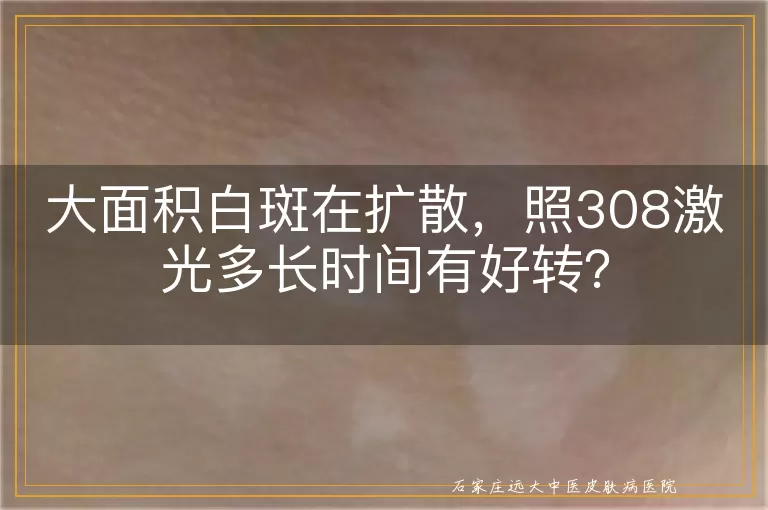 大面积白斑在扩散，照308激光多长时间有好转？