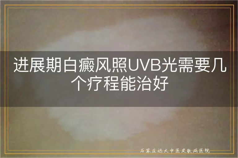 进展期白癜风照UVB光需要几个疗程能治好