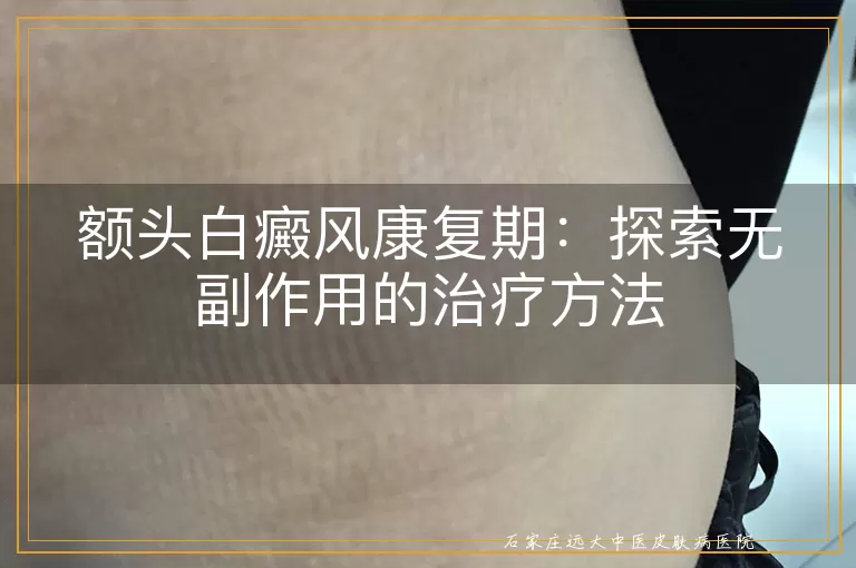 额头白癜风康复期：探索无副作用的治疗方法
