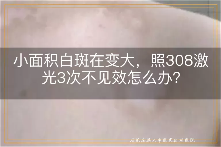 小面积白斑在变大，照308激光3次不见效怎么办？