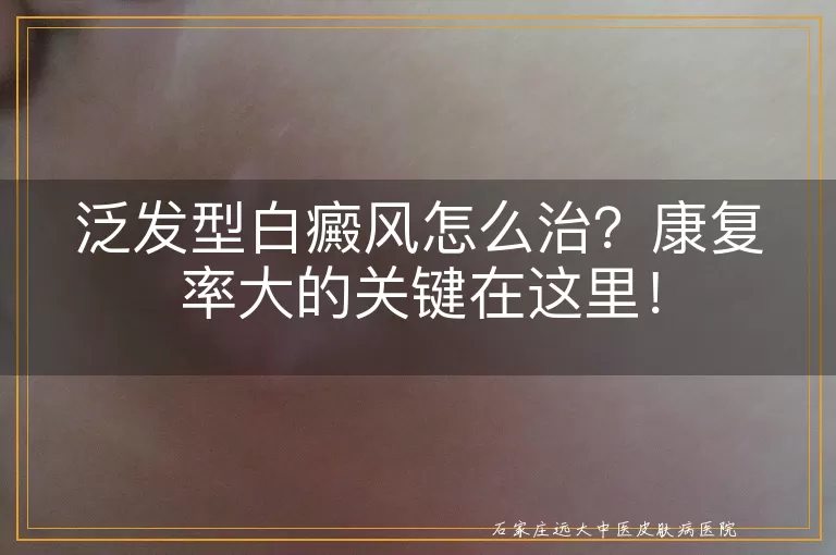 泛发型白癜风怎么治？康复率大的关键在这里！