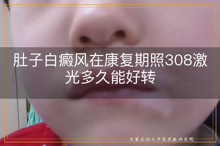 肚子白癜风在康复期照308激光多久能好转