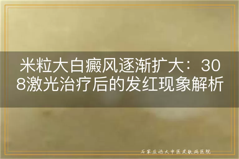 米粒大白癜风逐渐扩大：308激光治疗后的发红现象解析