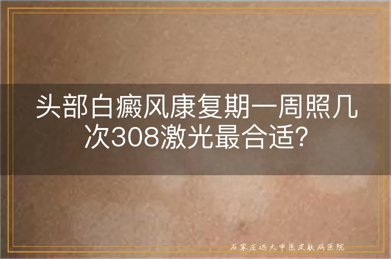 头部白癜风康复期一周照几次308激光最合适？