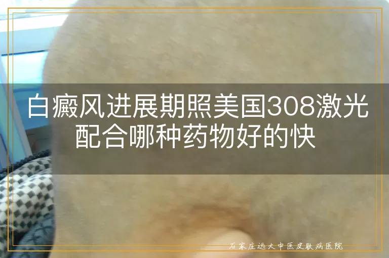 白癜风进展期照美国308激光配合哪种药物好的快
