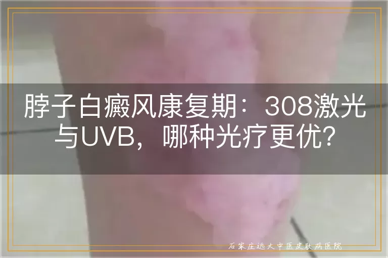 脖子白癜风康复期：308激光与UVB，哪种光疗更优？