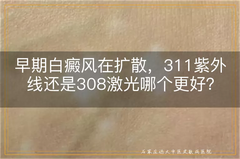 早期白癜风在扩散，311紫外线还是308激光哪个更好？